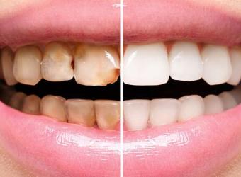 Caring for Restored Smiles: Tips for Long-lasting Dental Work